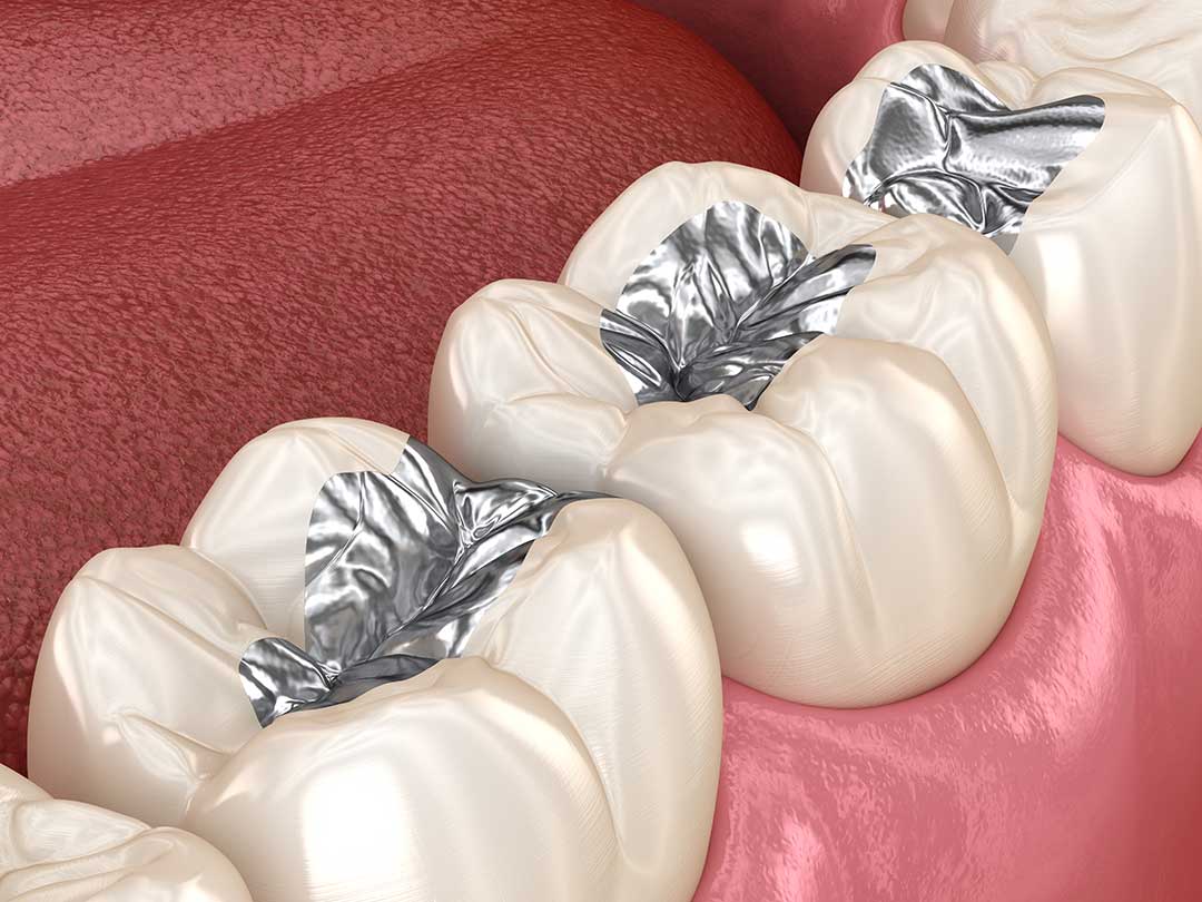 Dental Amalgam: When Is Replacement Necessary? AR