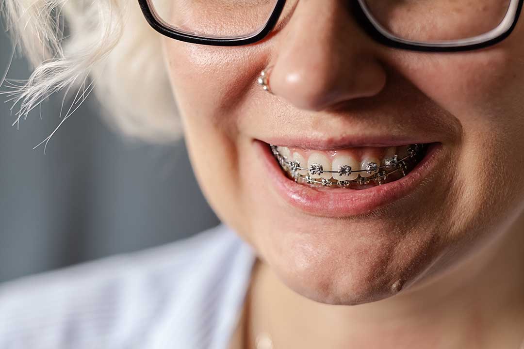 How Long Will My Braces Treatment Take?