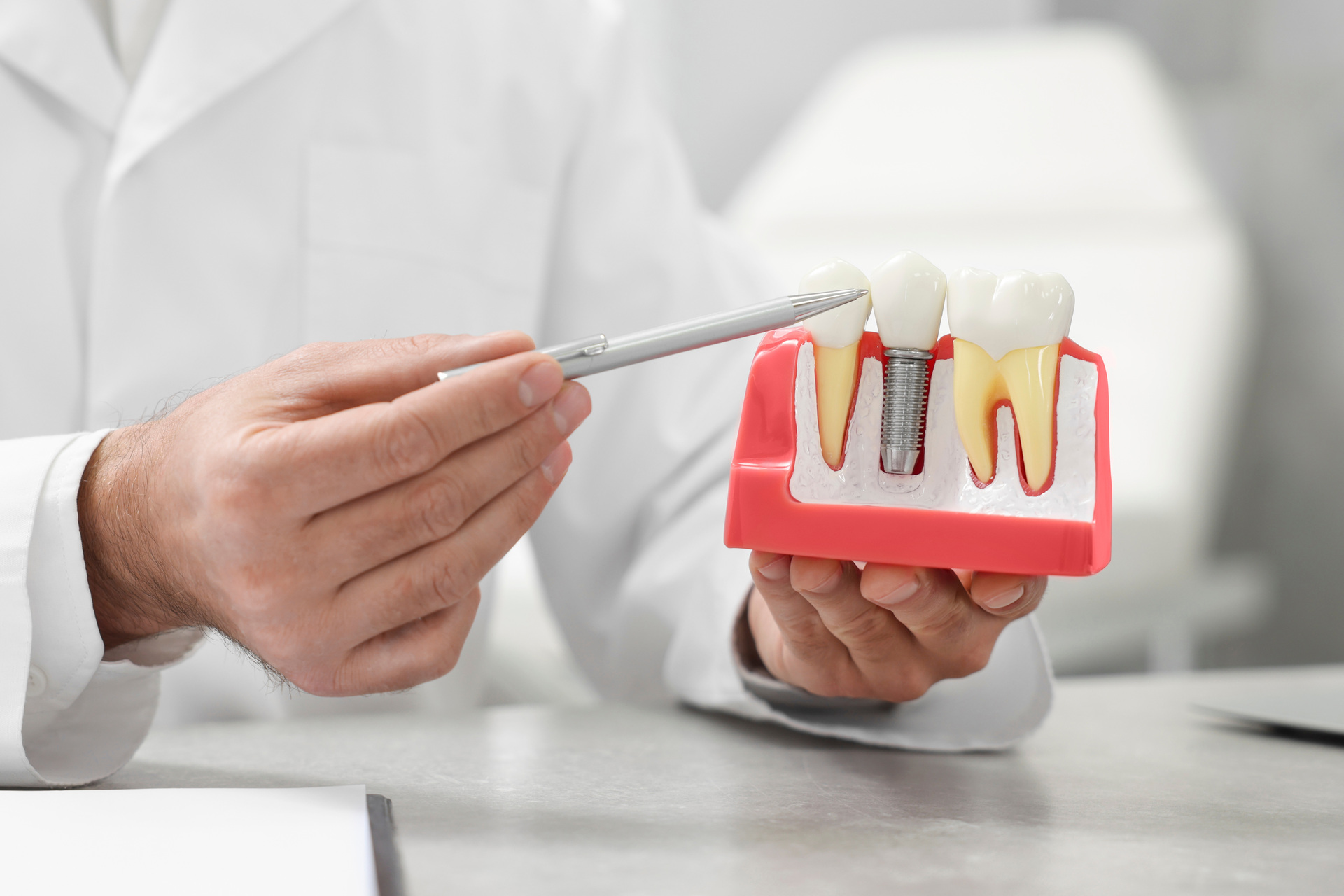 What Are Dental Implants? Surgery, Types, Purpose, and Benefits