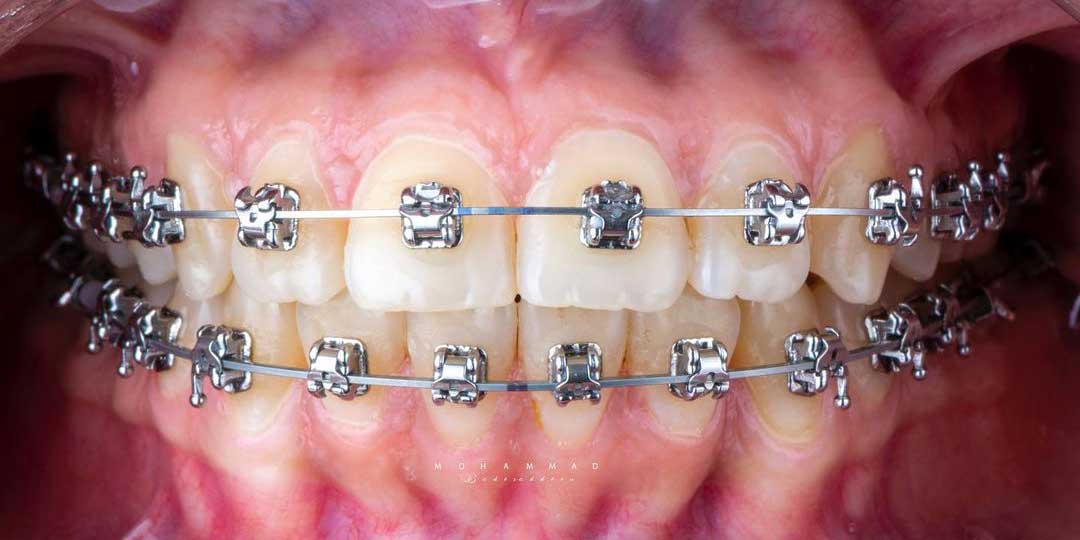 Close-up of a mouth with braces, showing properly aligned teeth after successful crossbite correction.
