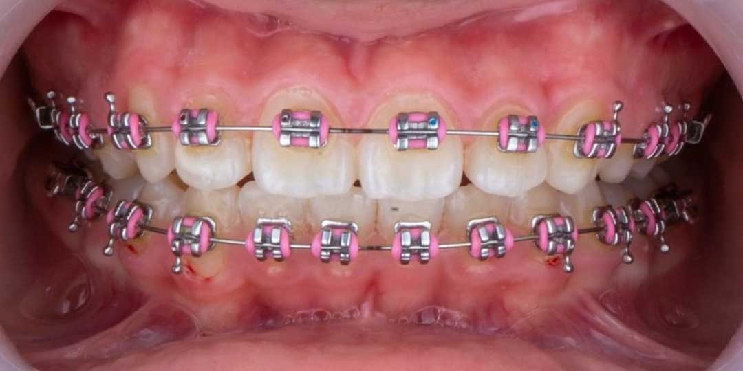 Close-up photo of a child's mouth showing well-aligned teeth after successful treatment for openbite issues.