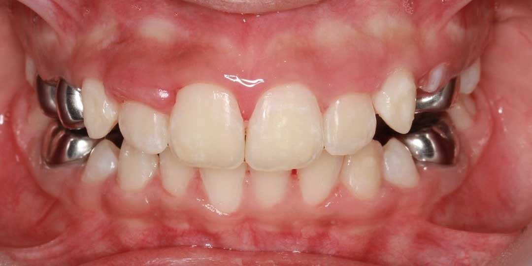 Close-up photo of a child's mouth showing well-aligned teeth after successful treatment for spacing issues.