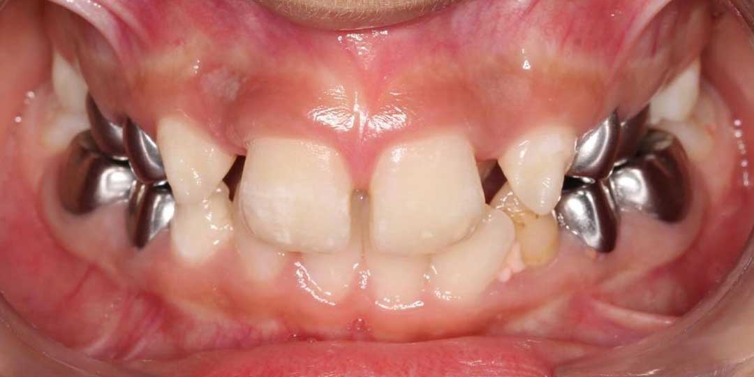 Close-up photo of a child's mouth with crowding.