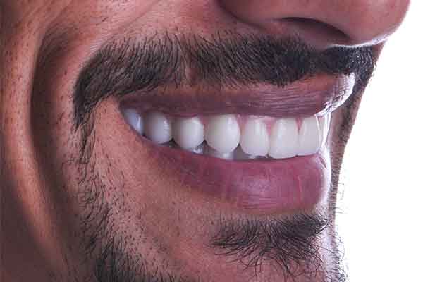 ما هي مدة زراعة الأسنان؟