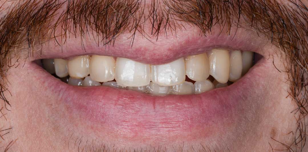 Before in-office teeth whitening treatment