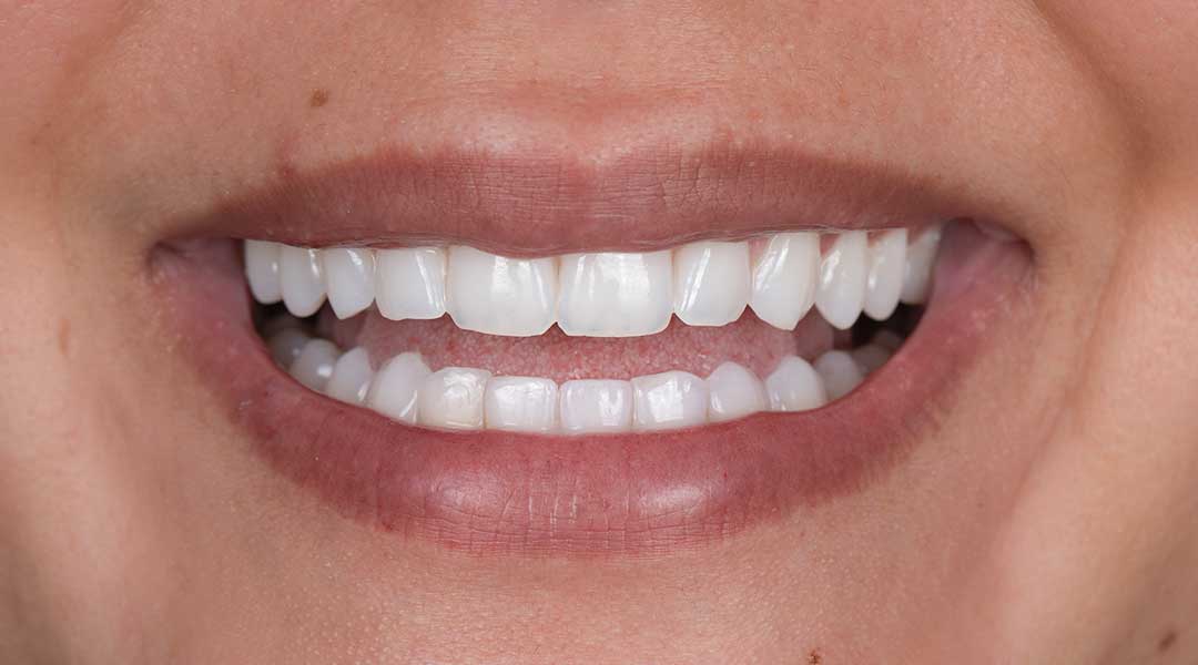 After teeth whitening treatment and Guided Biofilm Therapy at Harmony Medical Center