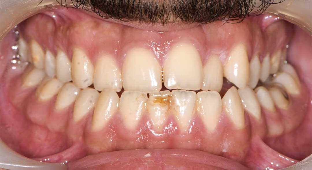 before treatment with braces