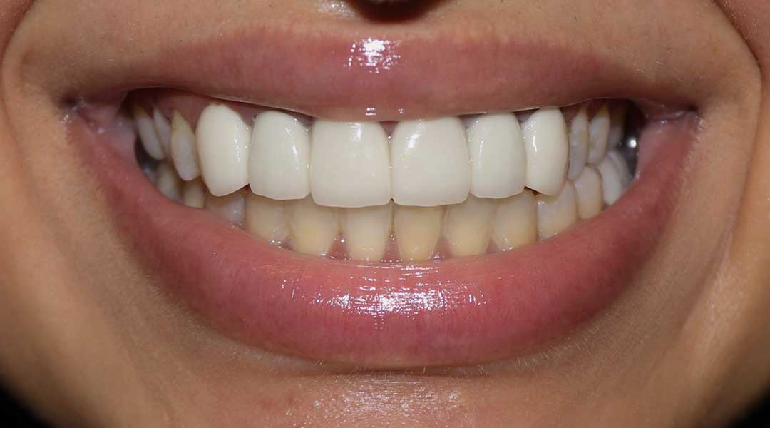 Before Crowns Treatment