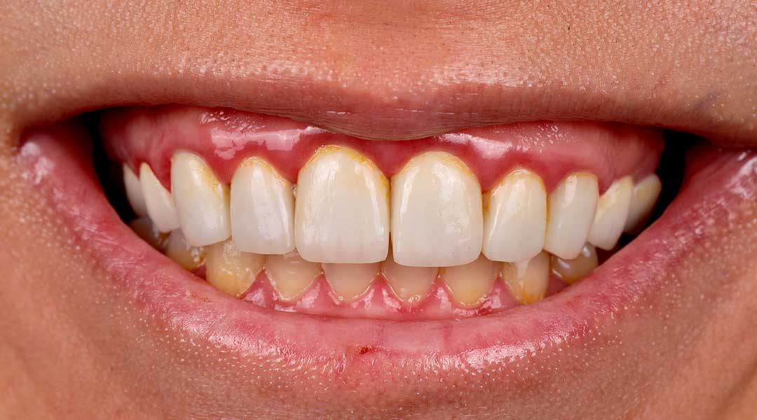 Before Gum Treatment