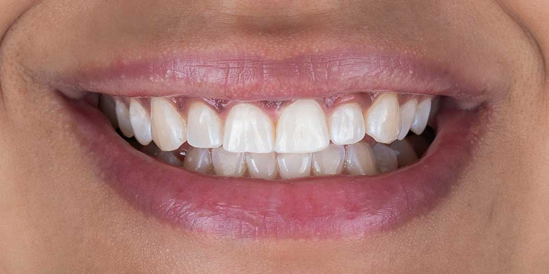 After Teeth Whitening