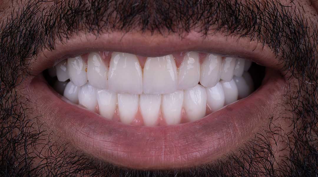 full mouth rehabilitation abu dhabi