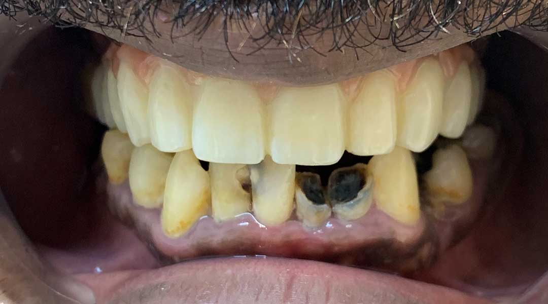 full mouth rehabilitation abu dhabi