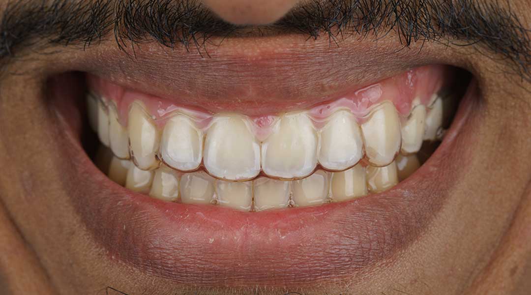 After Invisalign Treatment