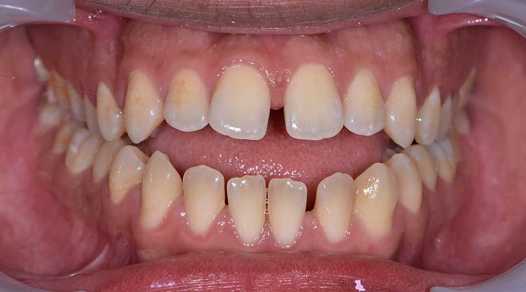 Before Invisalign Treatment