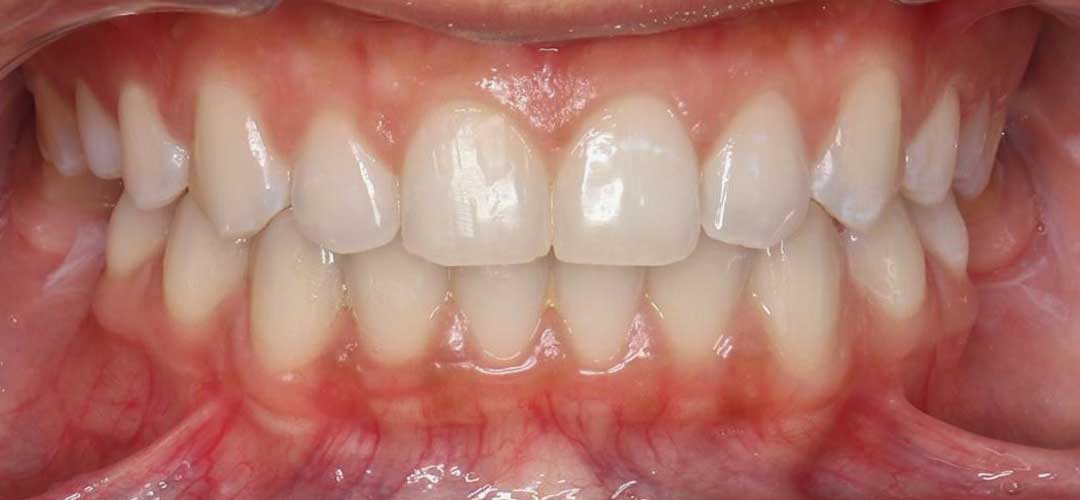 Photo showing front teeth of a patient after braces treatment with Dr. Karam Kharsa