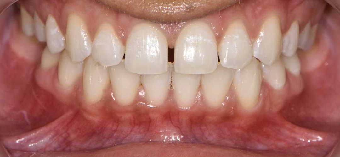 Photo showing anterior view of a patient's teeth before braces treatment with Dr. Karam Kharsa