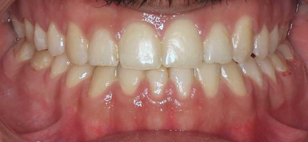 Photo showing teeth of a patient after braces treatment with Dr. Karam Kharsa