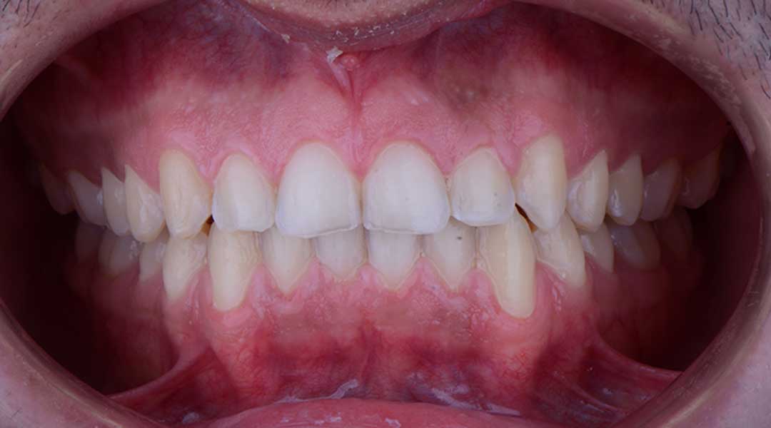 After Invisalign Treatment
