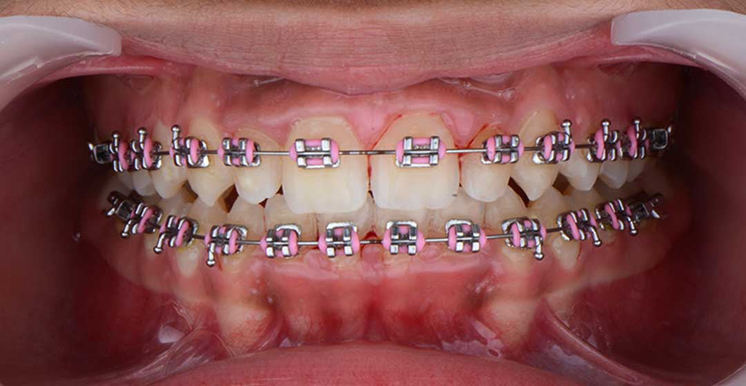 Final phase dental treatment with braces