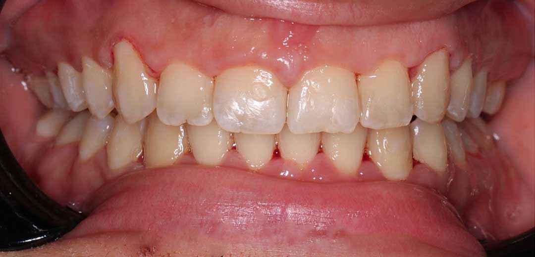 After treatment with braces