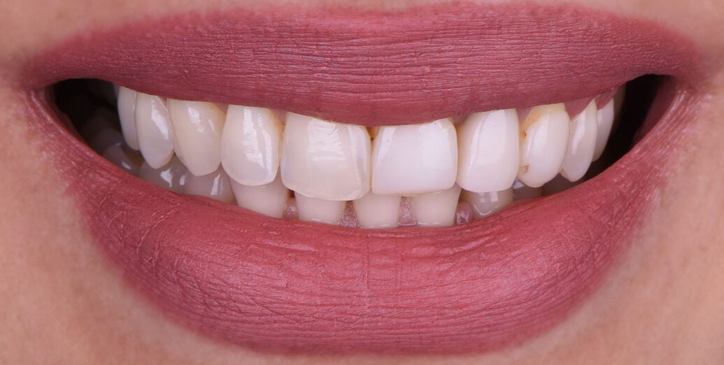Before veneers treatment with Dr. Oussama Alaoui