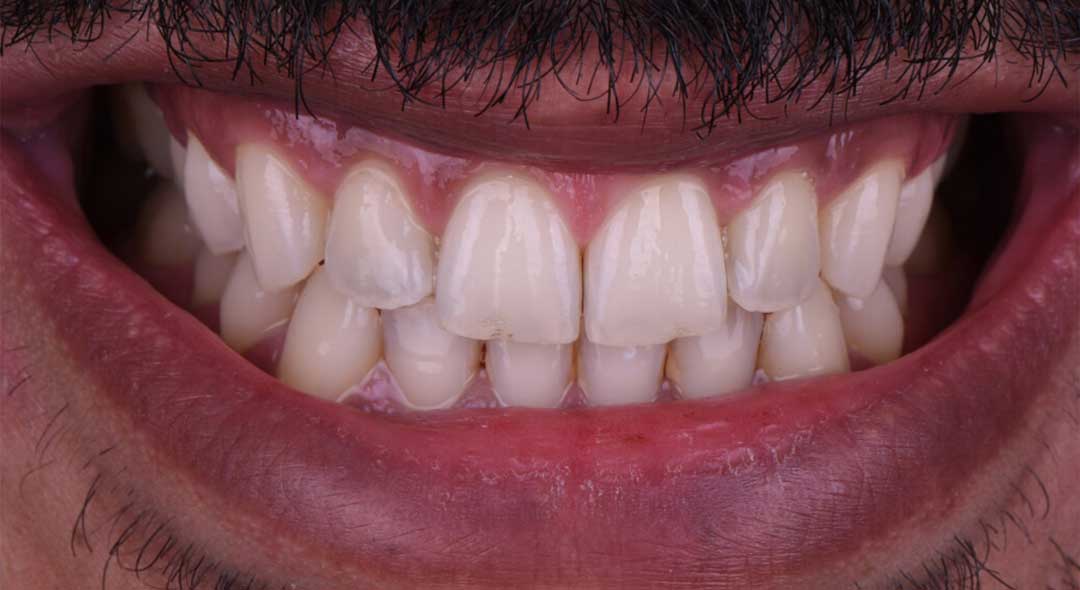 Before veneers treatment with Dr. Oussama Alaoui