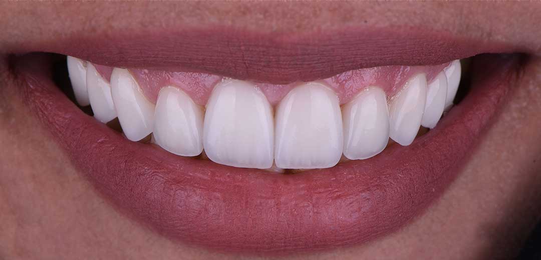 After Veneers Treatment