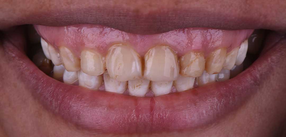 Before Veneers Treatment