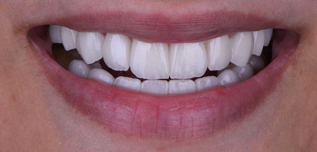 After Smile Makeover