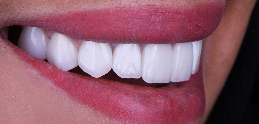 After veneers treatment