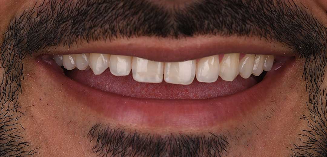 Photo of a smile before smile makeover treatment with Dr. Roula Kilani