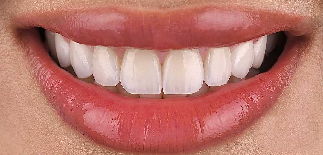 Close-up of a female patient’s new smile refreshed with natural looking and evenly shaped veneers by Dr. Roula Kilani at Harmony Medical Center in Dubai