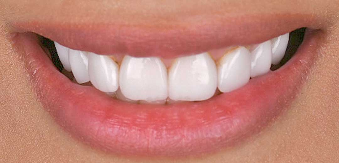 Close-up of a smile with worn, stained dental restorations before smile makeover treatment with Dr. Roula Kilani at Harmony Medical Center in Dubai