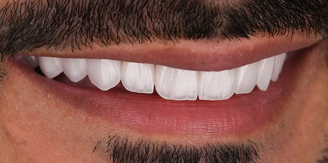 After veneers treatment