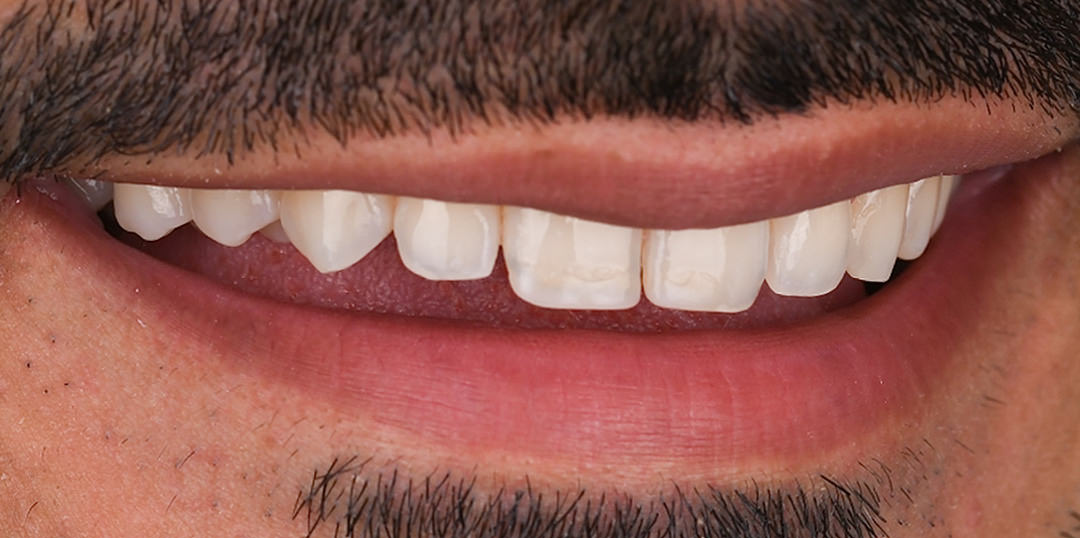 Before veneers treatment