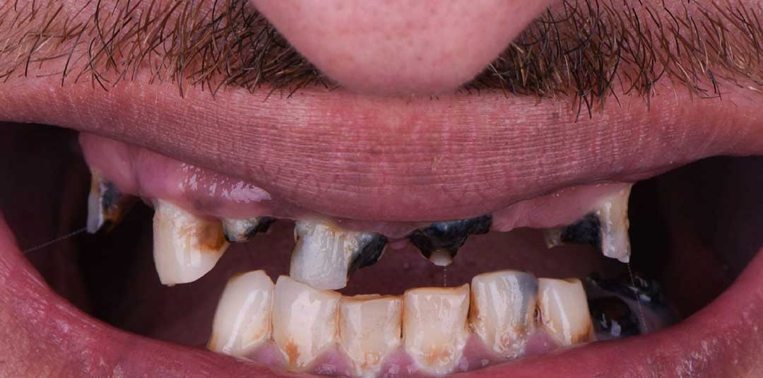 full mouth rehabilitation abu dhabi