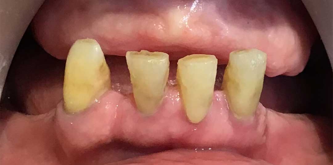 full mouth rehabilitation