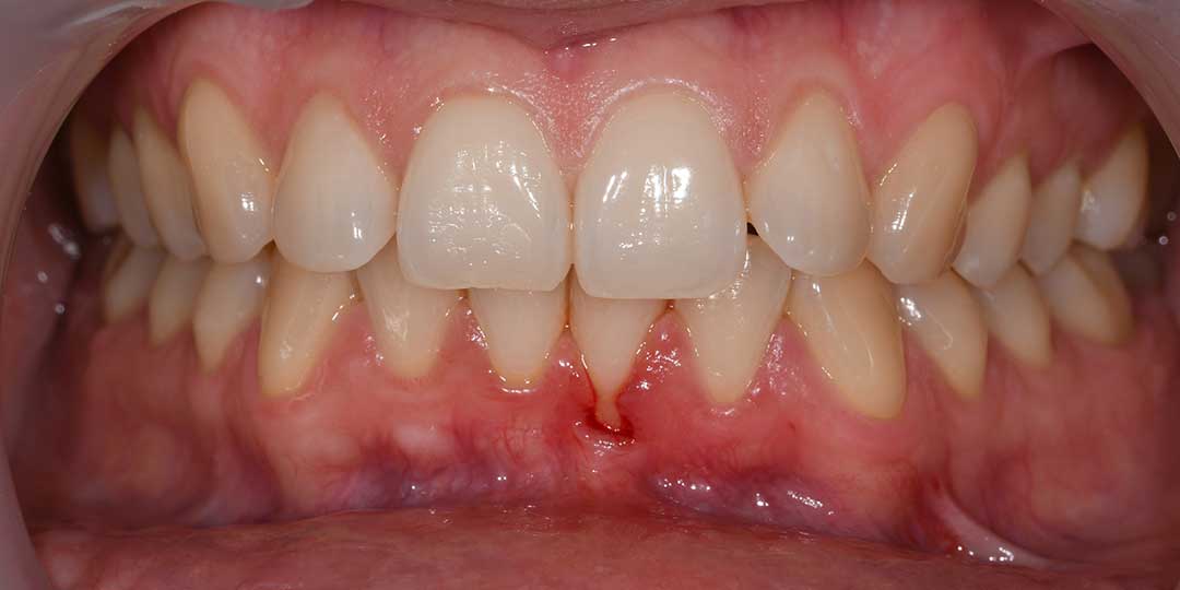 Before Gum Recession Treatment