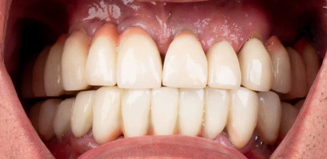 same day dental implants near me dubai