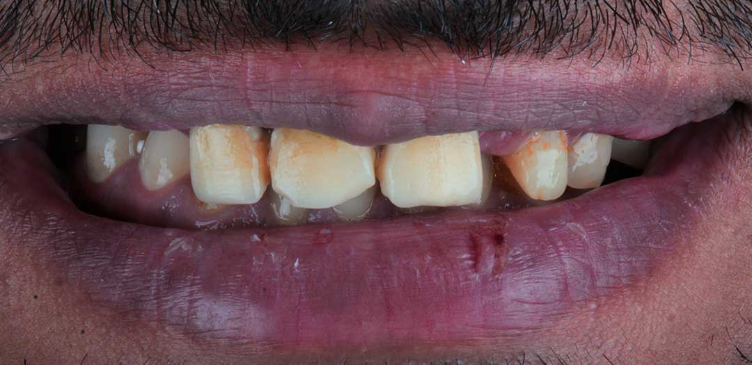 same day dental implants near me