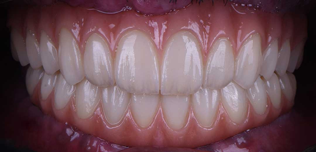 After dental implants
