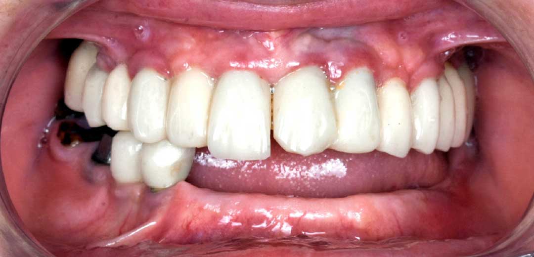 same day dental implants near me abu dhabi