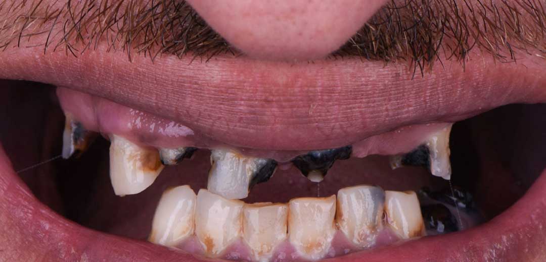 Before dental implants