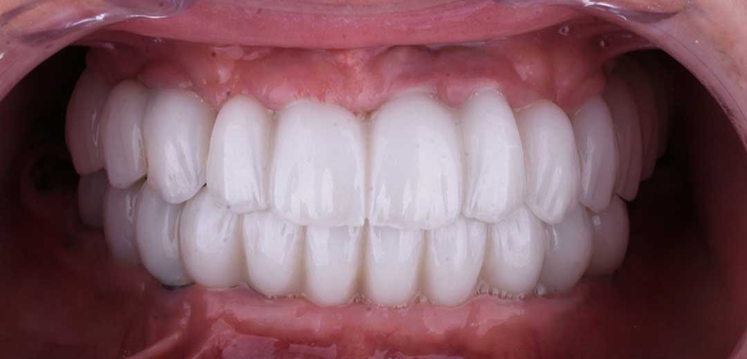 After dental implants