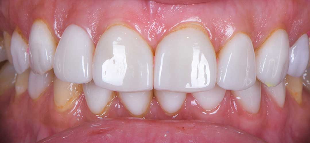 Before veneers treatment