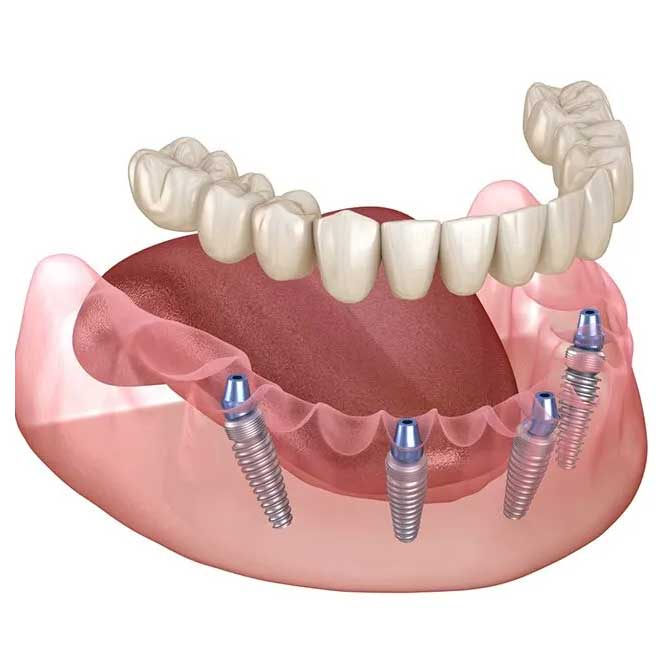 all on 4 dental implants near me