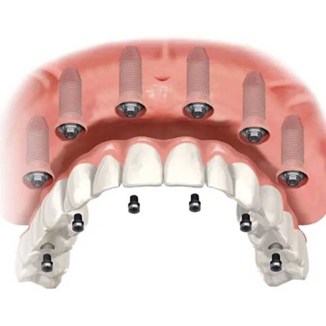 all on 6 dental implants - harmony