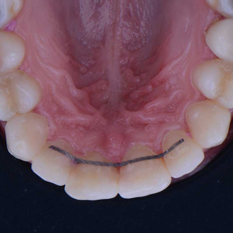 Fixed lingual retainers at Harmony Medical Center