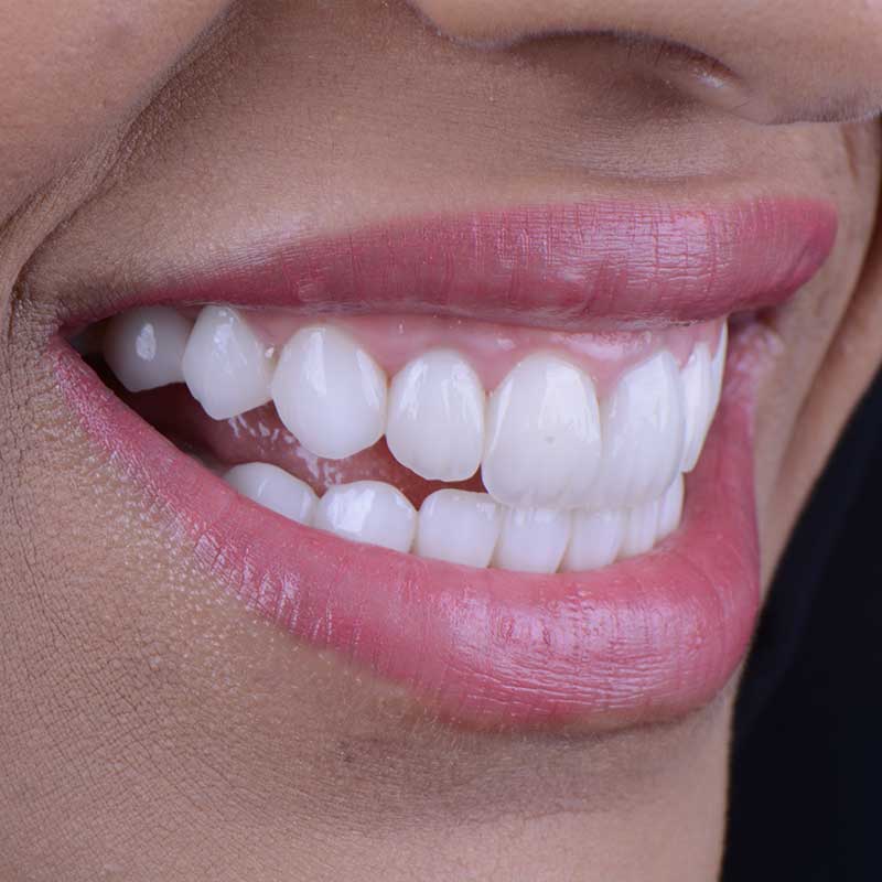 A smiling patient at Harmony Medical Center showing beautiful, healthy, and even gums.