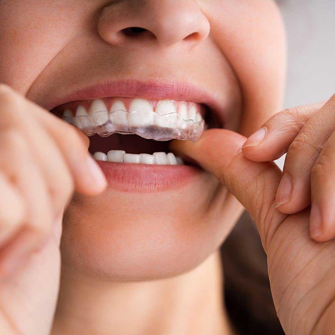Close-up of a woman about to wear her night guards to protect her teeth during sleep.